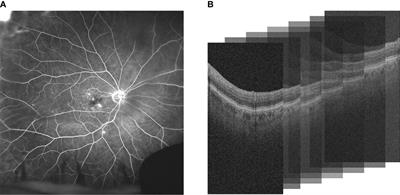 Evaluating the utility of deep learning for predicting therapeutic response in diabetic eye disease